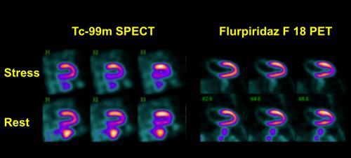 Flurpiridaz PET phase 3 study PET vs SPECT for overall CAD detection (n=755) Screened 920 Dosed 795 Discontinued 31 PET