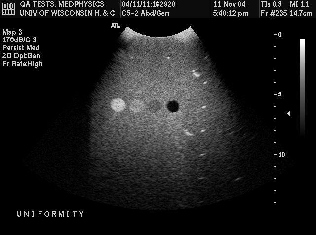 Have sonographic features similar to soft