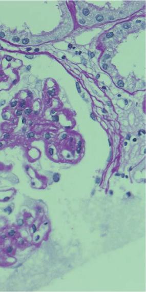 (c) Masson trichrome (MT) staining showed red staining in the subepithelial area (original magnification 400). were all normal.
