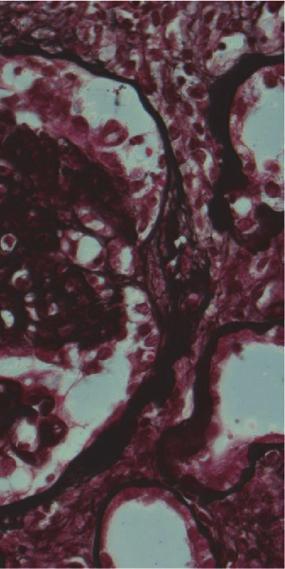 Light microscopy showed diffuse thickening of the glomerular capillary walls with focal mesangial proliferation (Figures 1(a) and 1(b)), and red staining was observed in the subepithelial area by