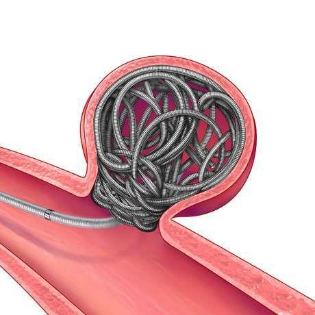 For Coils with nominal sizes mm The System is indicated for the embolization of: Intracranial aneurysms Other neurovascular abnormalities such as arteriovenous malformations and arteriovenous