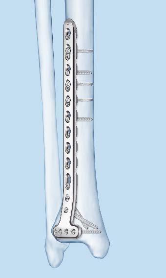 3.5 mm LCP Distal Tibia T-Plates Long plate features Anatomically shaped Two elongated holes for