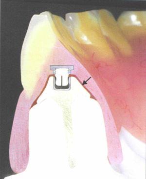 A B Ceka attachment used for example Ceka attachment used for example Figure A is an overdenture fabricated without the large spacer.