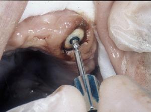 Option 2: Chairside Pick-Up of the Female Attachments Direct Placement by the Dentist 2 Put a