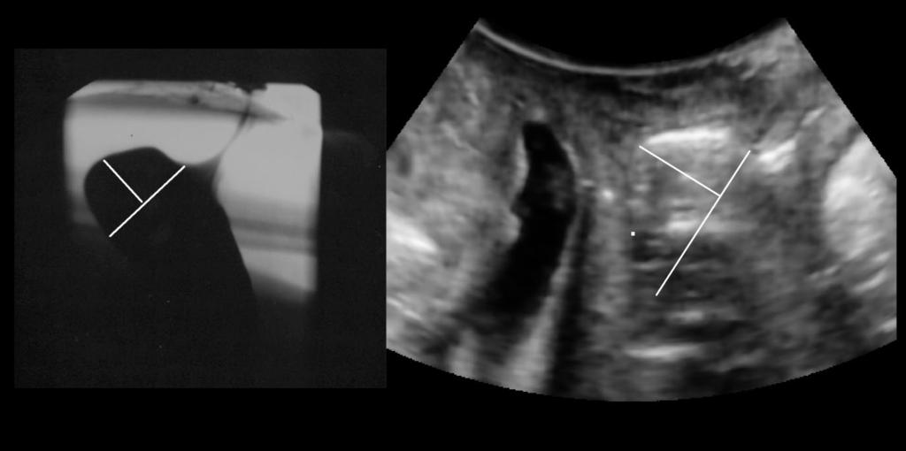 568 Perniola et al. Figure 1 Rectocele on defecation proctography (a) and translabial ultrasound (b).