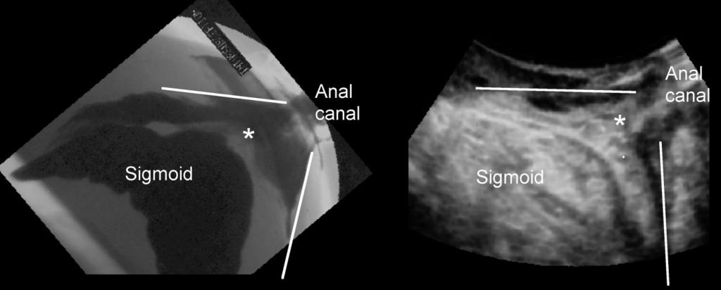 Proctography versus ultrasound 569 Figure 2 Rectal intussusception on defecation proctography (a) and translabial ultrasound (b). The lines show splaying of the anal canal.