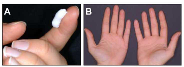 Administrationoftopicalsteroids The fingertip rule A fingertip= 0.