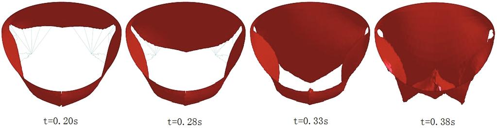 Finite Element Analysis for Edge-to-Edge Technique to Treat Post-Mitral Valve Repair Systolic Anterior Motion 9 Fig. 8.