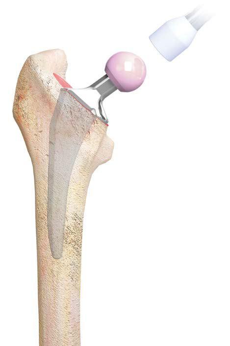 Femoral Head Impaction Following the final trial reduction, clean and dry the femoral stem taper to ensure it is free of debris.