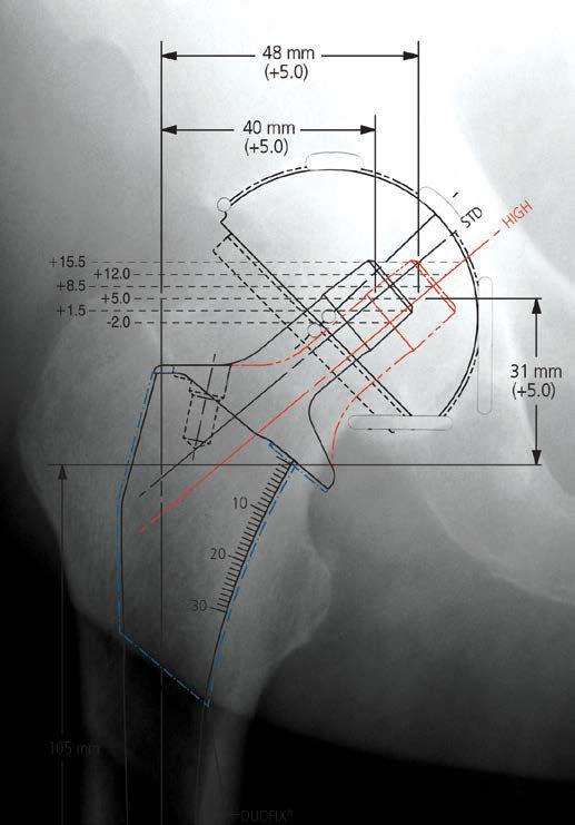 Femoral Stem Selection Select the template size that fits the proximal femur and equalizes leg lengths.