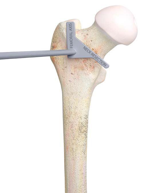 Femoral Neck Osteotomy Align the neck resection guide with the long axis of the femur. This establishes the angle of resection at a proper from the femoral axis.