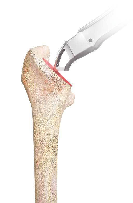Femoral Canal Preparation Utilize the modular box osteotome with the broach handle to enter the femoral canal and to establish version.