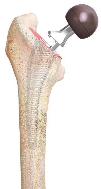 Trial Reduction Trial neck segments and trial heads are available to assess proper component position, joint stability, rangeof-motion and leg length.