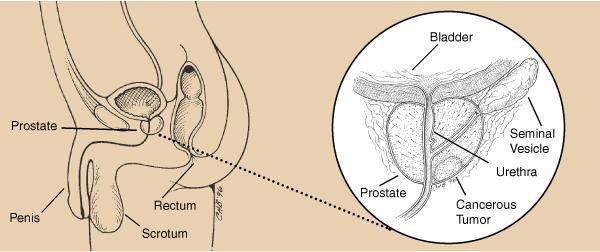 1 Medical Topics - Prostate Cancer PROSTATE CANCER What is Prostate Cancer?