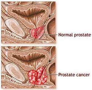 2 Medical Topics - Prostate Cancer What are the symptoms of Prostate Cancer? Prostate cancer may cause no signs or symptoms in its early stages.