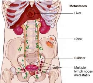3 Medical Topics - Prostate Cancer What are the risk factors of Prostate Cancer?