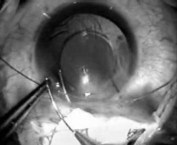 This tactile lag between appearance of only the tip first, with no limbal or corneal distortion, and then the rest of the probe (Khalil sign), is an important sign of success.