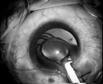 If widening the incision is needed to implant the lens, a closure 10/0 suture will be needed more often than not to prevent anterior chamber shallowing on subsequent corneal traction for completion