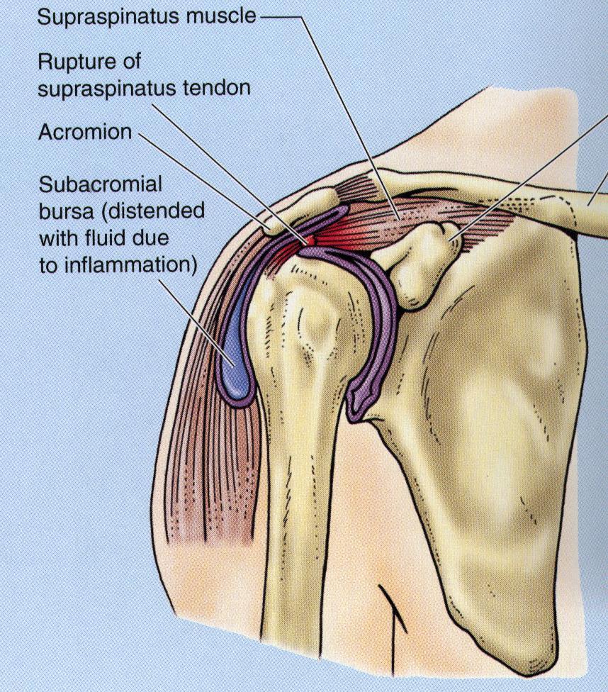Trauma can tear or rupture one or more tendon (s) forming the cuff.