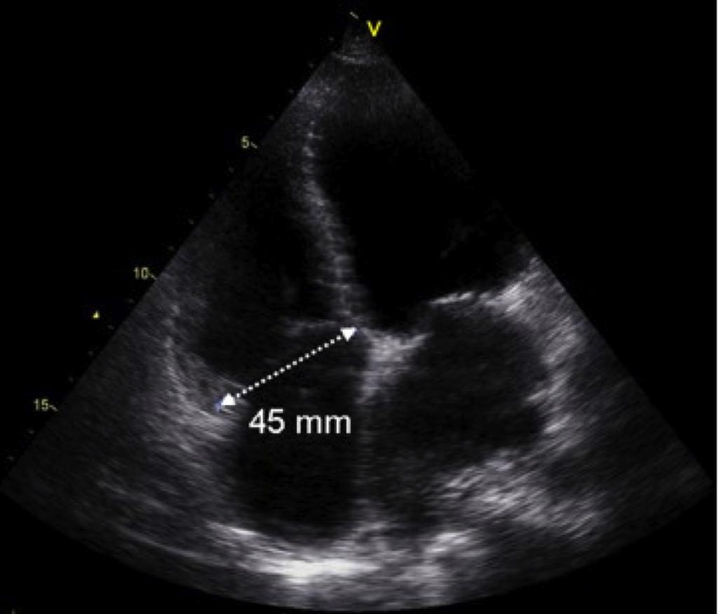 Structured approach to functional tricuspid regurgitation 209 mitral regurgitation, stringent downsizing by 2 ring sizes was performed.