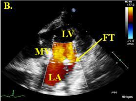 transducer (FT) within the sheep subject, the left ventricle (LV), left atrium (LA), and mitral valve (MV) are labeled; (C) Transducer within the simulator displaying similar flow patterns and