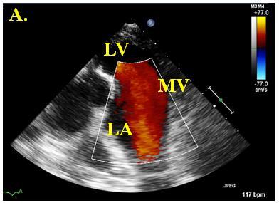 Figure 6-5 (A) Doppler echocardiographic image of mitral inflow from the Left Atrium (LA) to the Left Ventricle (LV) in absence of the annular Force Transducer (FT); (B) Implanted transducer