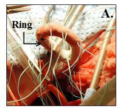 Figure 6-10 (A) Ten 2-0 sutures are placed through the suture cuff of the annuloplasty ring transducer for implantation, (B) While on cardiopulmonary bypass the transducer is