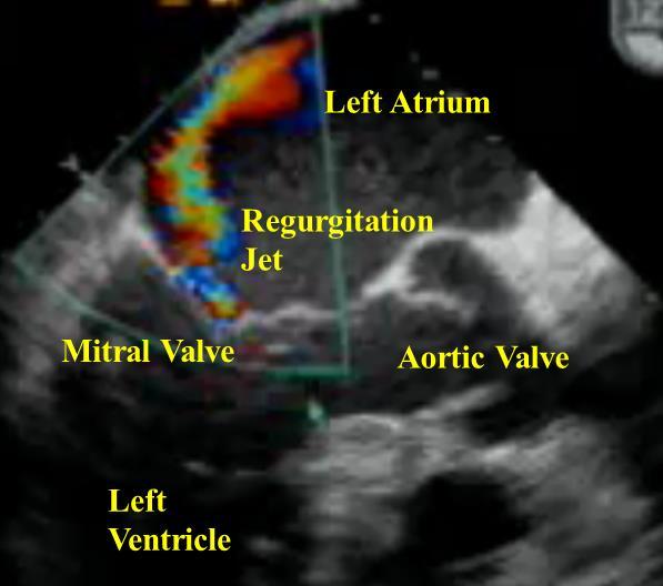 pattern of LV infarction and dilatation [53,57,58]. In combination, these geometric distortions result in asymmetric leaflet tethering and asymmetrically directed regurgitation jets (Figure 2-7).