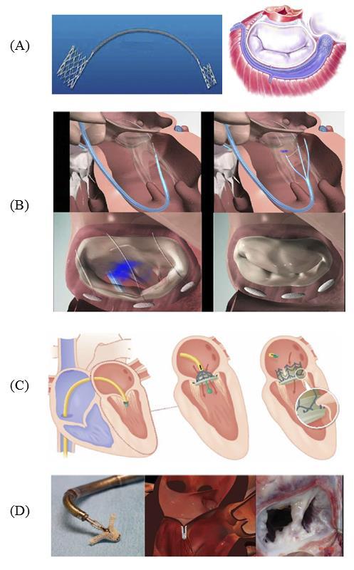 Figure 2-10 Examples of different percutaneous MV devices that include (A) the Monarc device for indirect annuloplasty, (B) the Mitralign device for