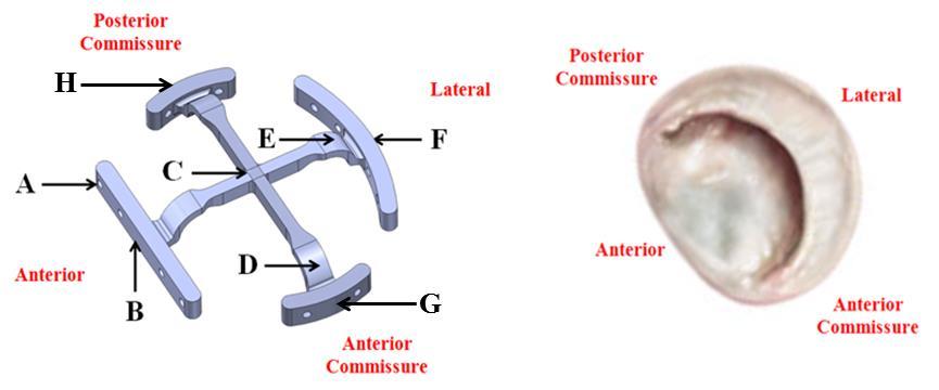 Figure 5-1 Left: Spring element of the designed annular force transducer with selected highlights: (A) through holes for suturing the device to the mitral valve annulus, (B) anterior transducer arm,
