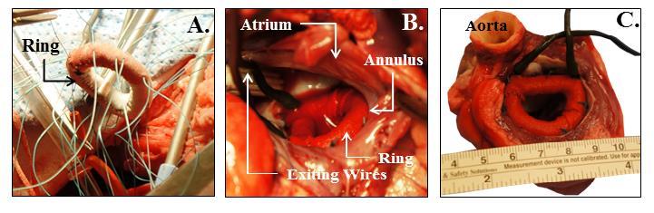 Figure 5-16 (A) Ten 2-0 sutures are placed through the suture cuff of the annuloplasty ring transducer for implantation, (B) While on cardiopulmonary bypass the transducer is implanted to the mitral
