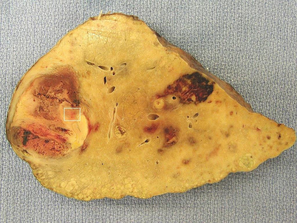 Explanted liver from patient treated with SIR-Spheres.