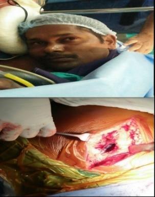 surgery done at Osmania General Hospital. HHF had provided Uncemented Imported Implant, partly supported Rs.