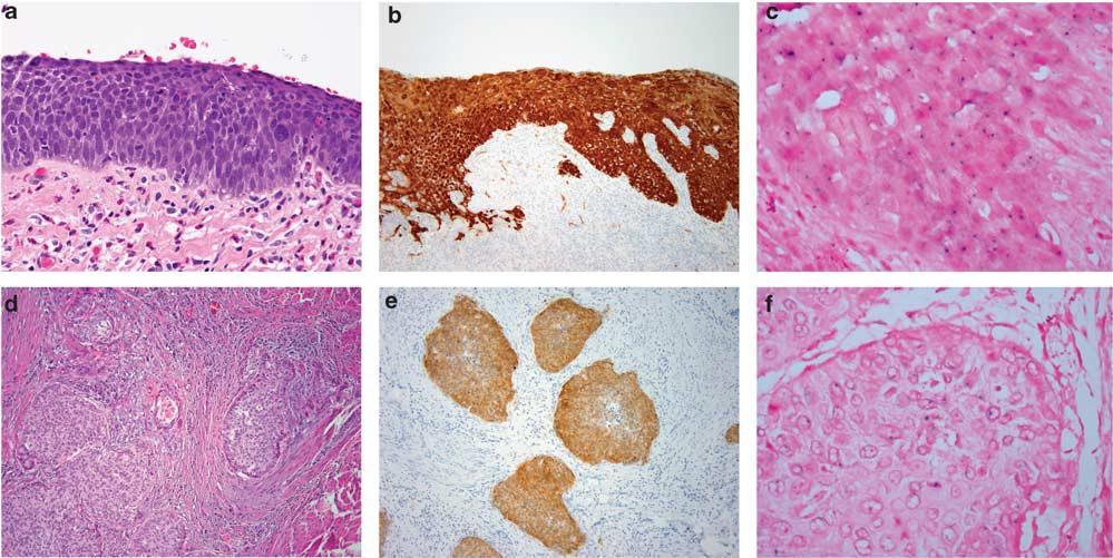 Modern Pathology (2012) 25, 1534 1542 UROTHELIAL CARCINOMA WITH PROMINENT SQUAMOUS DIFFERENTIATION IN THE SETTING OF NEUROGENIC BLADDER: ROLE OF HUMAN PAPILLOMAVIRUS INFECTION EB Blochin et al Figure