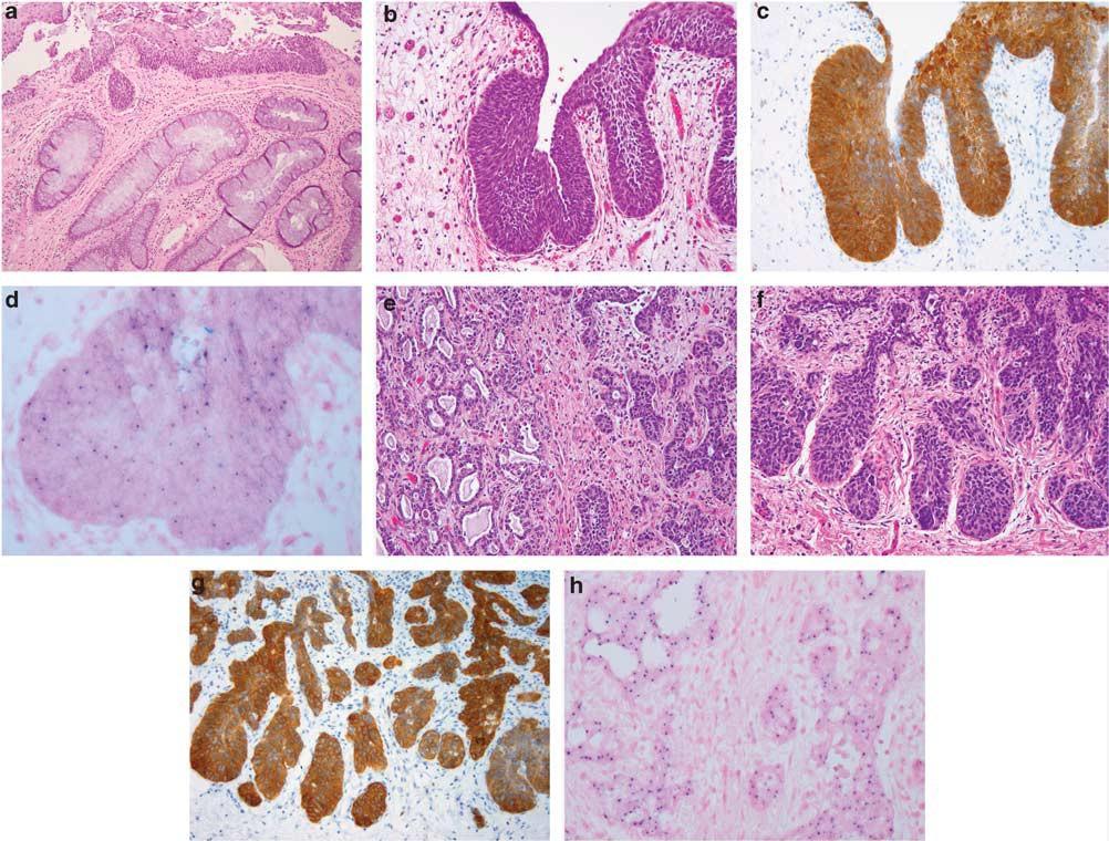 Modern Pathology (2012) 25, 1534 1542 UROTHELIAL CARCINOMA WITH PROMINENT SQUAMOUS DIFFERENTIATION IN THE SETTING OF NEUROGENIC BLADDER: ROLE OF HUMAN PAPILLOMAVIRUS INFECTION Figure 2 Patient 2: (a)