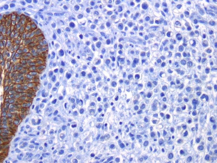 Plasmacytoid/Signet Ring Cell Carcinoma of the Bladder
