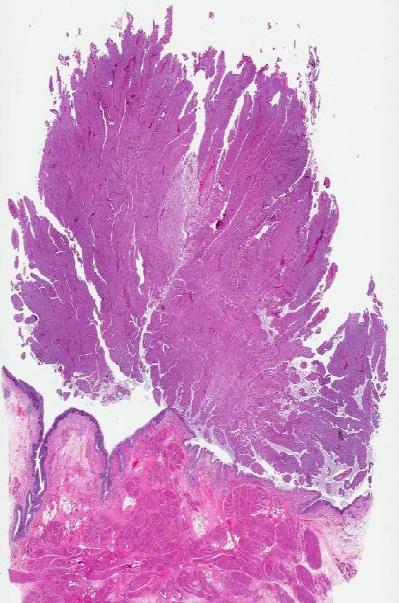 mutation of fibroblast