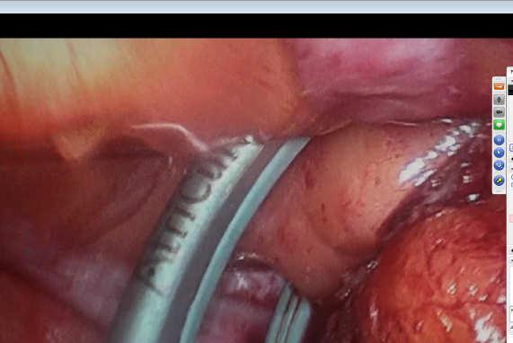 CS cannulation and transseptal puncture Create Right