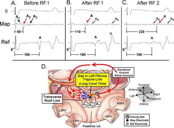 Assessing Conduction Block Across Surgical Linear Ablation Lesions Assessing Conduction Block Across Surgical