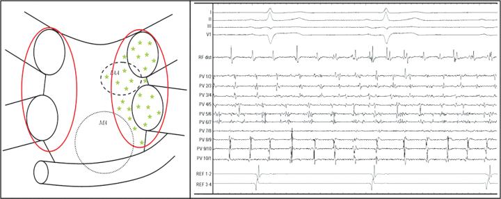 Fibrillating Areas Within the LA after Linear Catheter Ablation Fibrillating Areas Within the LA after