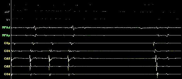 Ablation Ablation of Atypical Left Atrial