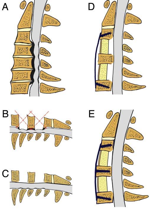 Skip corpectomy in patients with CSM Fig. 1. Illustrations showing pre- (A) and postoperative (B E) cervical spines treated with skip corpectomy.