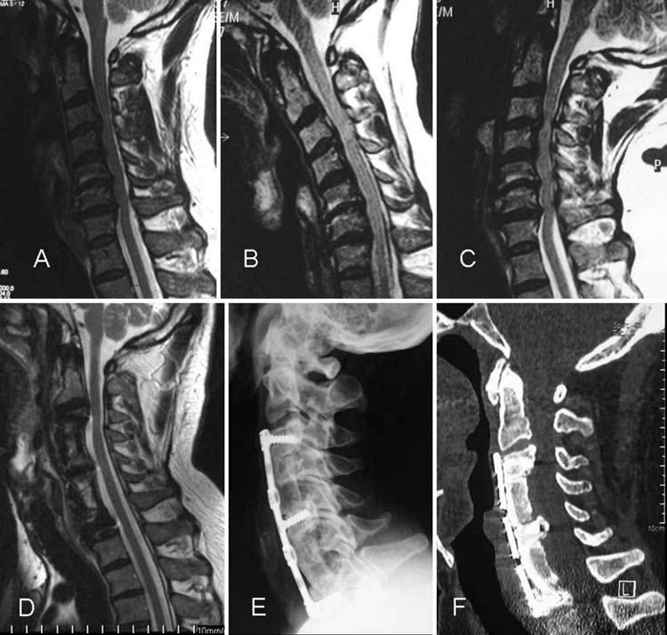 S. Dalbayrak, M. Yılmaz, and S. Naderi Fig. 2. Preoperative and postoperative MR images, postoperative CT scan, and plain radiographs obtained in a patient who underwent skip corpectomy.