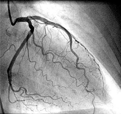 Coronary angiogram Methods Patient workup Significant CAD: 70% of stenosis in one or more major coronary arteries