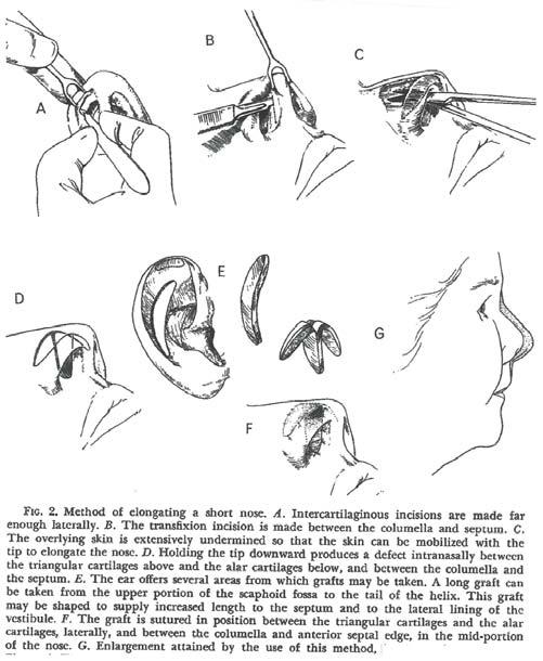 Surgical Treatment of Short Nose Dr. Otto YT Au MD (JEFFERSON, USA) 1957, MCPS (MANITOBA) 1963, FHKAM (SURGERY) 1995 Diplomate American Board Plastic Surgery Plastic Surgery Specialist Dr.
