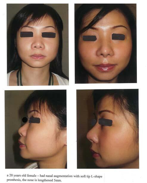 7 JULY 2008 Case 4 A 33 years old female who requested augmentation, she was advised to have the nose lengthened, composite ear cartilage graft was used, the nose was lengthened by