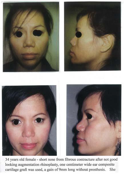 year before the nose was lengthened, a 1cm composite graft was used, the nose was lengthened by 8mm.