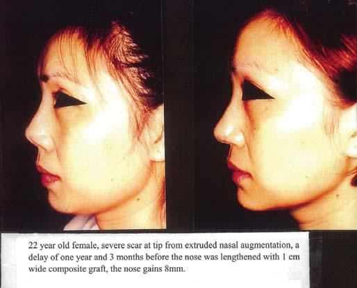 lengthened by 9mm composite ear cartilage graft, she also had fat injection to have a better facial contour.