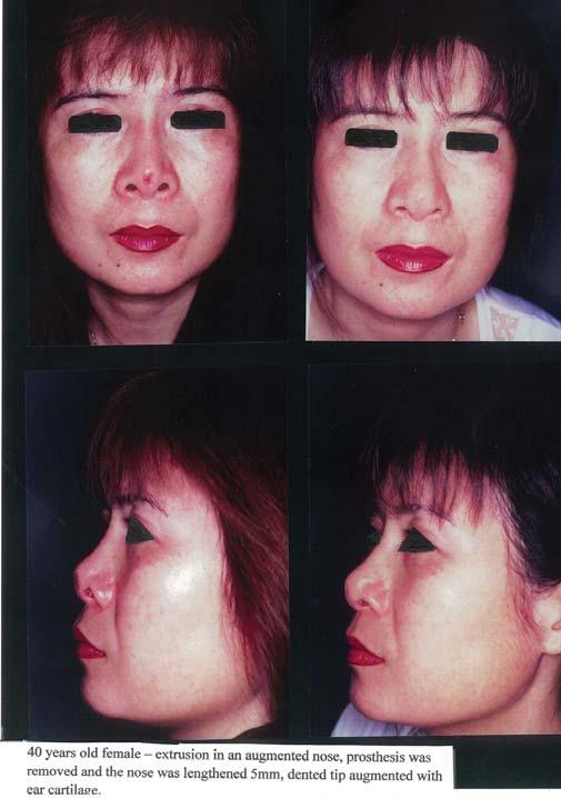 If the nose needs augmentation, a soft tip L shape prosthesis is used for this purpose.