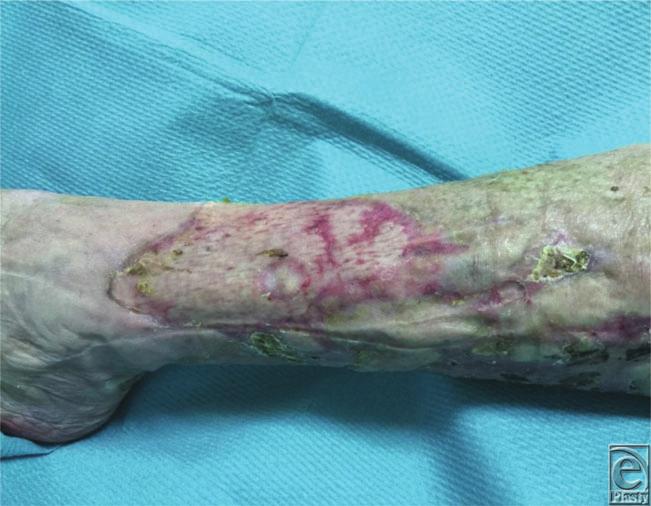 Figure 4. Wound bed at 3 weeks after skin grafting and systemic therapy with anti TNF alfa drug.
